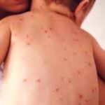 ബംഗ്ലാദേശില്‍ മാരകമായ അഞ്ചാംപനി പടരുന്നു; മരണസംഖ്യ 250 കടന്നെന്ന് റിപ്പോർട്ട്