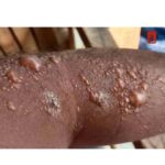 താനൂരില്‍ യുവാവിന് സൂര്യാതാപമേറ്റു.